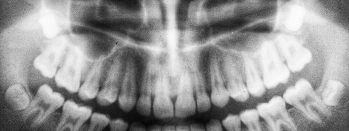 dental x-ray with that show the patients wisdom teeth